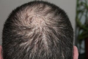 Hair loss on Keto